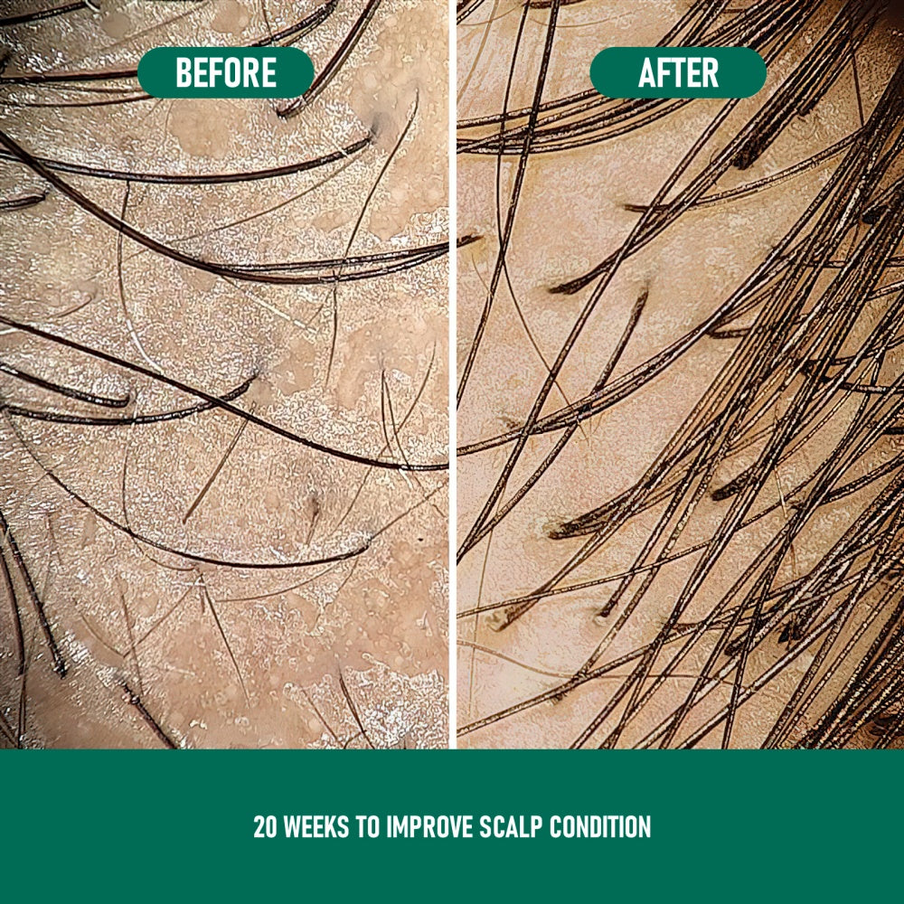 Professional Minoxidil Hair Mousse CH004 for Fuller, Healthier Hair